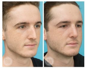 Rhinoplasty + Septoplasty