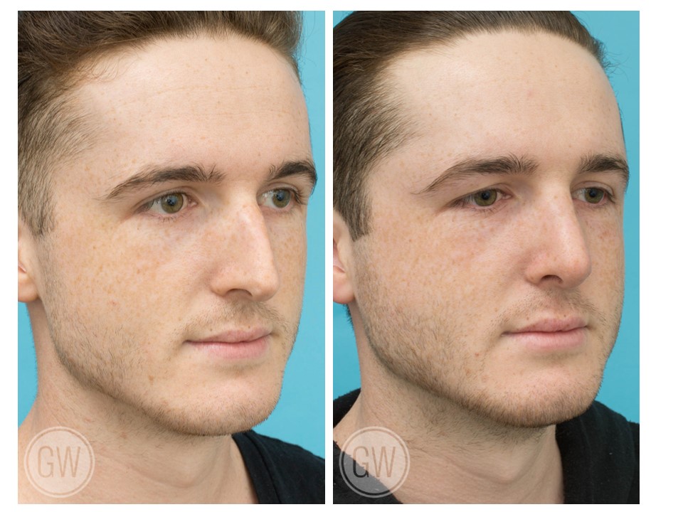 Rhinoplasty + Septoplasty