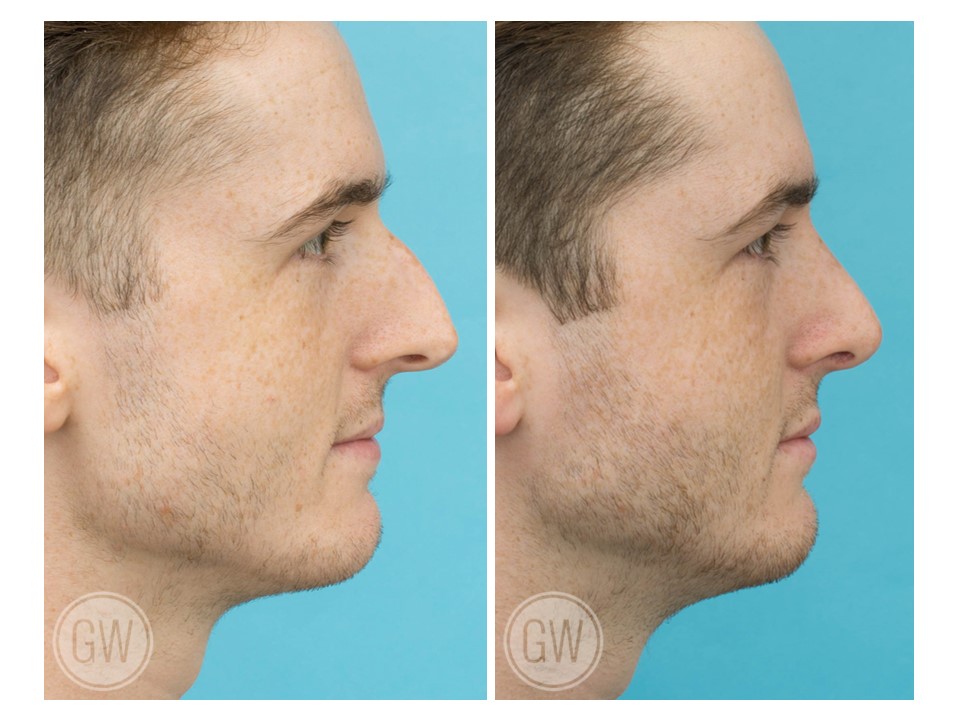 Rhinoplasty + Septoplasty