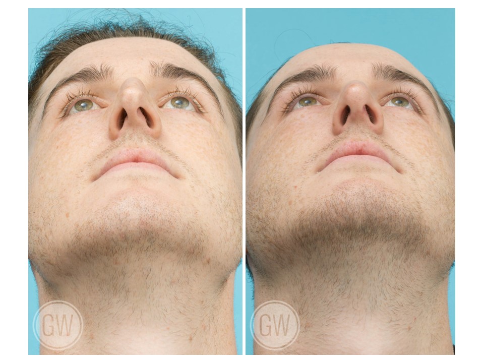 Rhinoplasty + Septoplasty